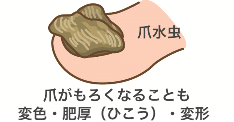 爪水虫でもケアしてもらえますか？