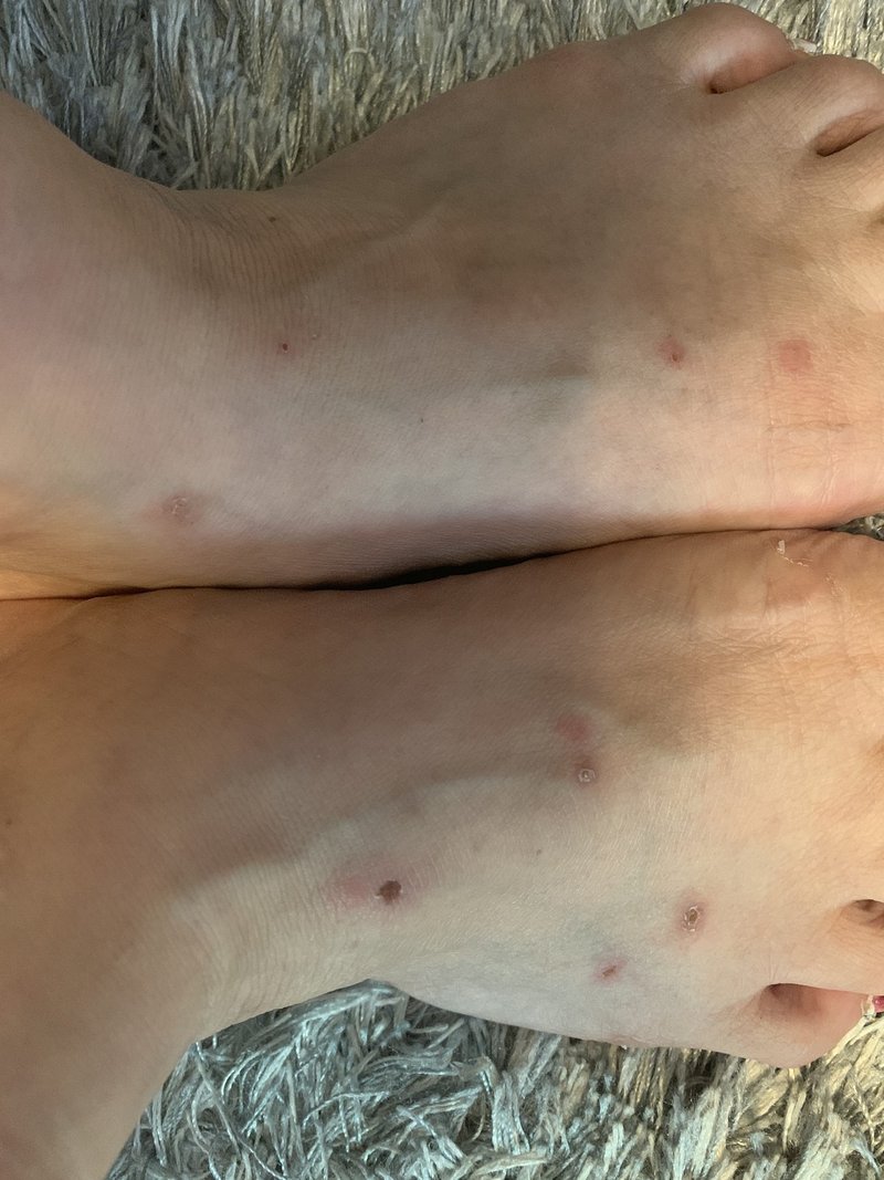 ダニ 刺され 画像