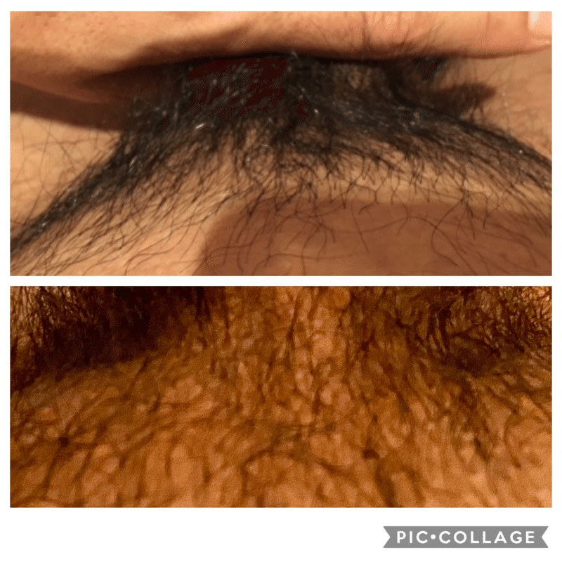 Vio6 回を重ねていき Vioメンズ医療脱毛7回の施術の効果 写真あり Kei S Aha Note