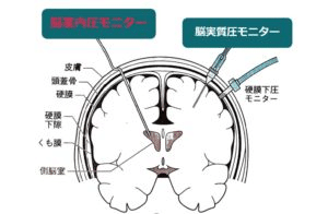 どんな時にicpモニターを考慮する ガイドラインより適応を解説 踊る救急医 Note