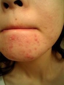 ニキビ跡が治ると話題の化粧水がスゴすぎる ﾟdﾟ Nikibiato Note