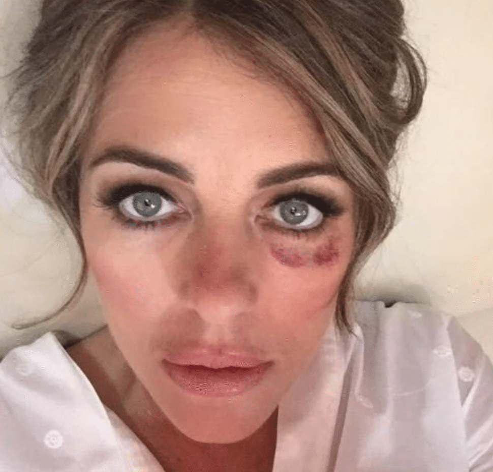 セレブの左目のアザ アドレノクロム Loveちゃん Note