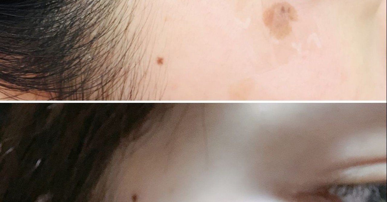 レーザーなんかいらない 自宅で簡単に顔のシミが取れた方法 ビート007 Note