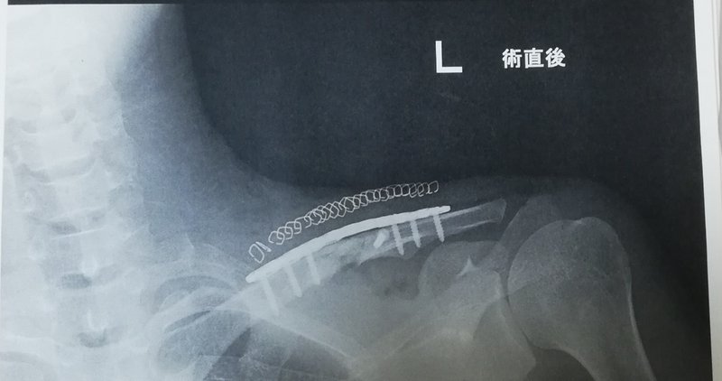 ライフハック 骨折しててもできる筋トレを考えよう 糊口屋 note