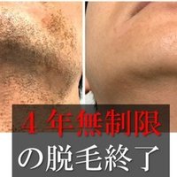 家庭用脱毛器 トリア で髭脱毛は完了する 特徴と利用者の評判を検証しました まるわかりメンズ脱毛 5年目 Note