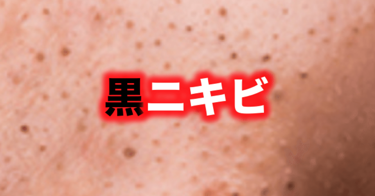 黒ニキビ 片柳ちひろ ニキビ博士 Note