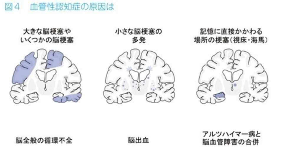脳血管性認知症 上松 正和 Note