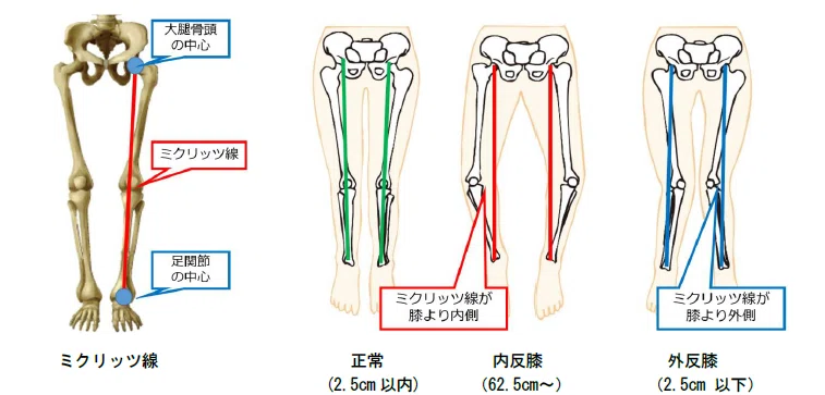 膝のアライメント ひかる パーソナルトレーナー Note