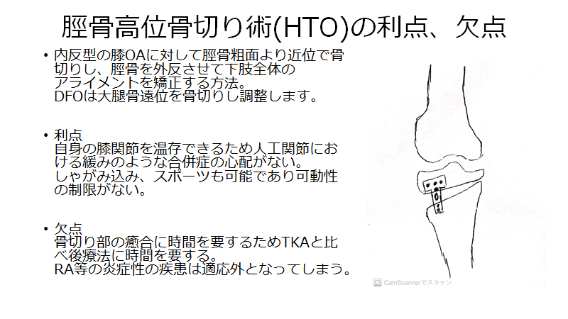 人工膝関節置換術の種類はいくつある？その適応、利点、欠点とは