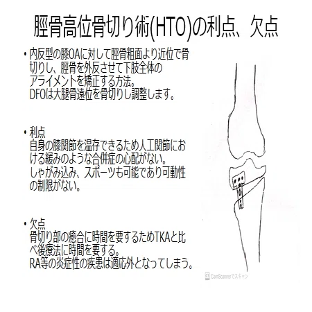 人工膝関節置換術の種類はいくつある？その適応、利点、欠点とは