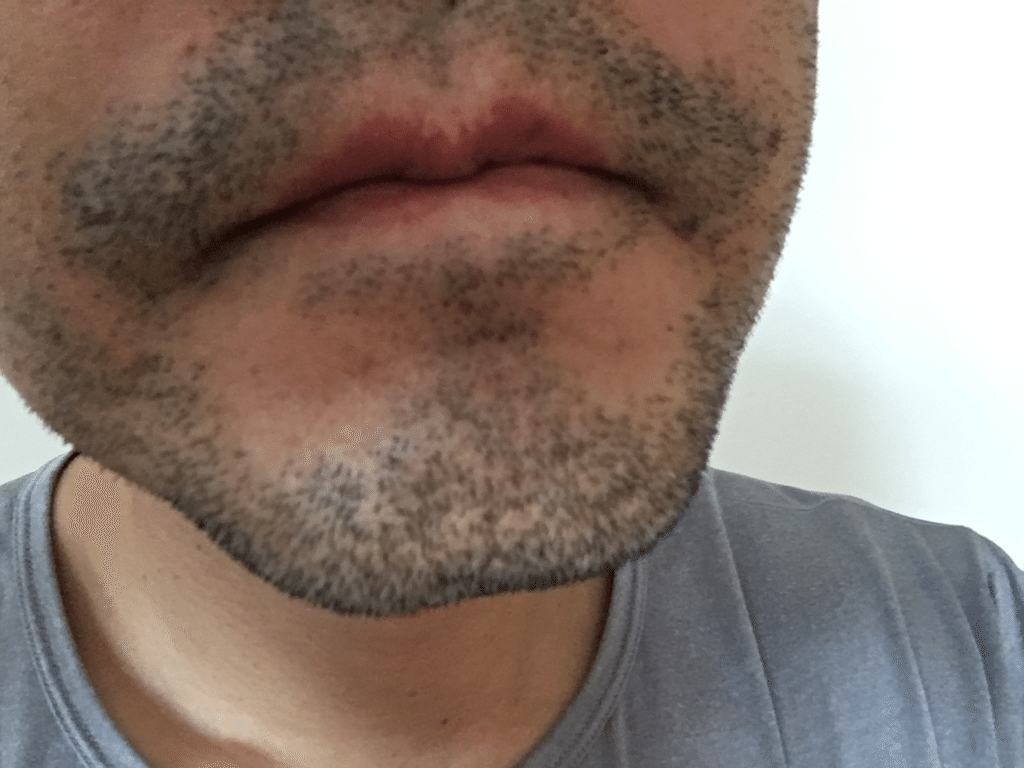 プリーツ 同行 後世 髭 脱毛 4 回目 Miyabina Jp