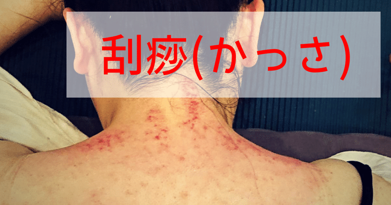 症例報告 一発で超スッキリ 刮痧 かっさ の即効性でガチガチ肩こりが解消 千葉道哉 東洋医学 リハビリテーション協会 Toras Note