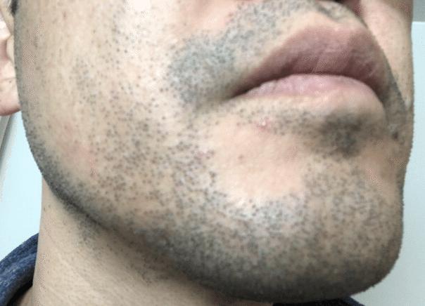 髭5 髭永久脱毛第7回から第9回の施術と経過観察 写真あり メディオスター出力アップ期 Kei S Aha Note