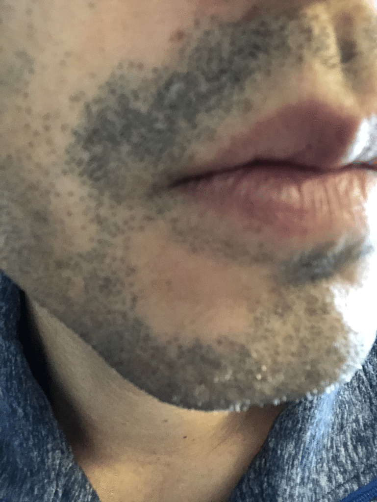 髭7 髭永久脱毛第11回施術 ついにヤグレーザー登場 ２年間のいらいらをふきとばせ Kei S Aha Note