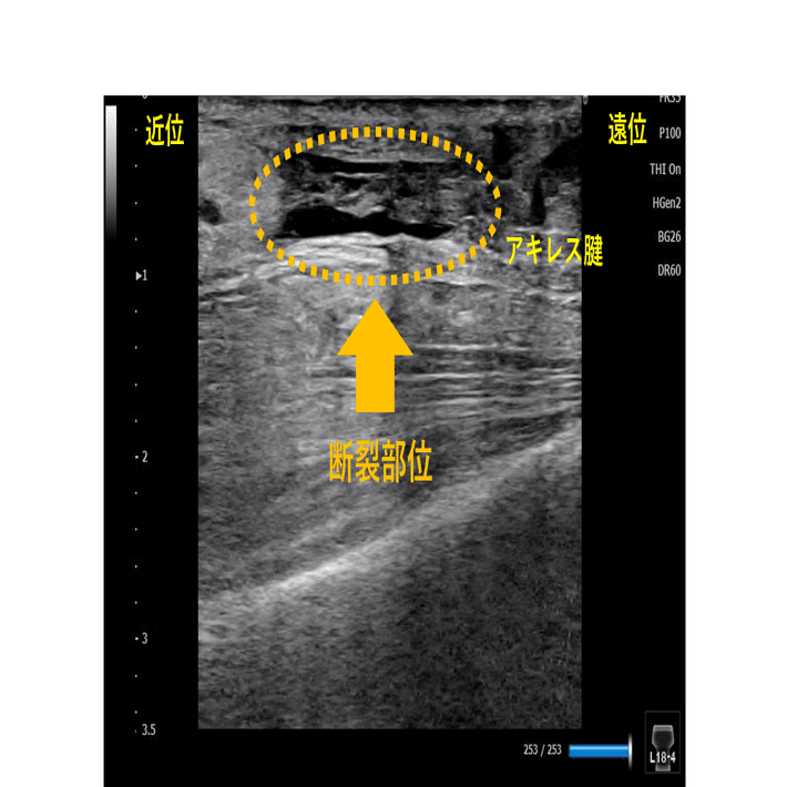 アキレス腱断裂 評価 介入編 Y K Note