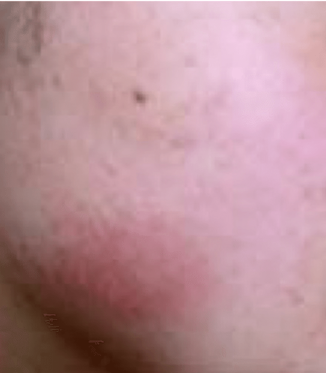 毛孔性角化症 片柳ちひろ ニキビ博士 Note