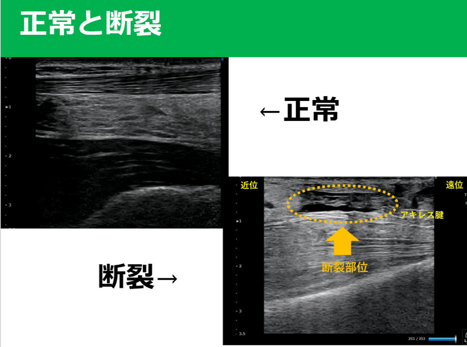 アキレス腱断裂 評価 介入編 Y K Note アキレス腱断裂 評価 介入編 Y K Note