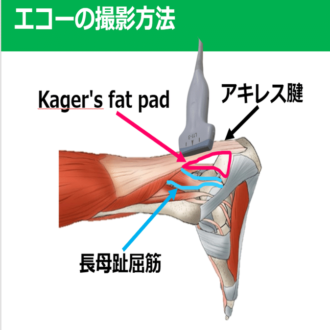 アキレス腱断裂 評価 介入編 Y K Note