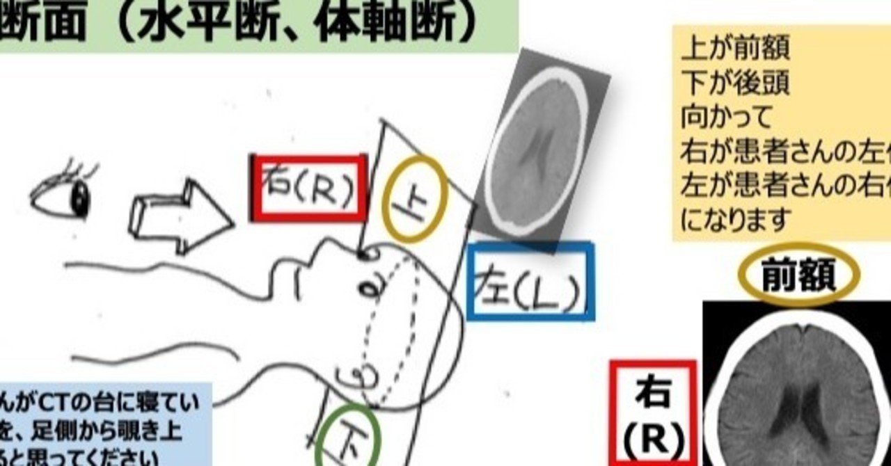 頭部ct画像の読み方 基礎編 脳出血は白 脳梗塞は黒 と丸覚えしてません のうと医療専門学校 Note