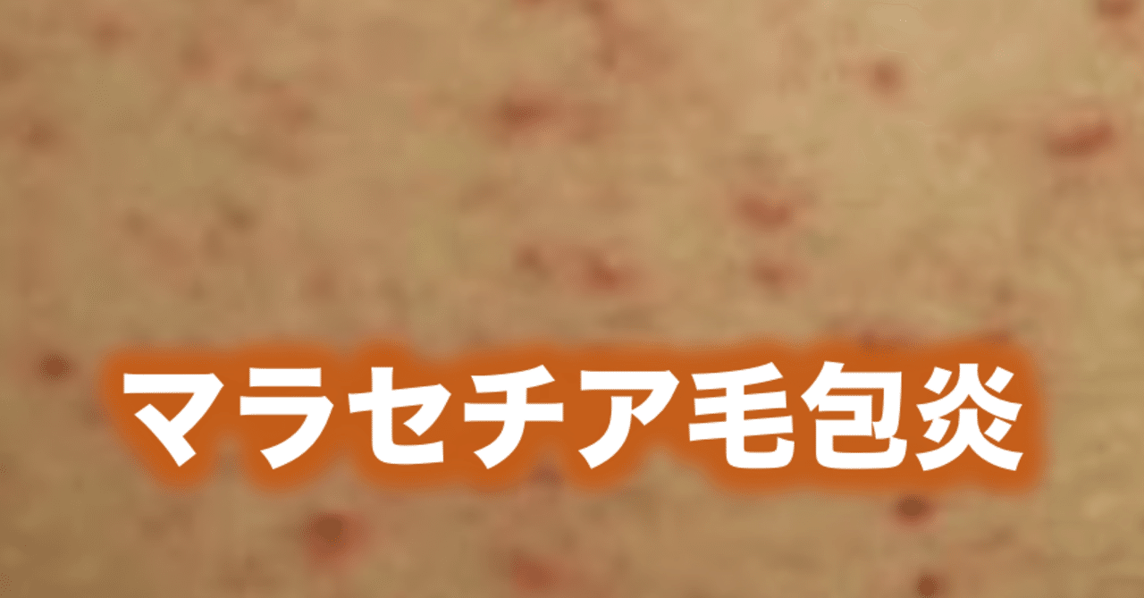 マラセチア毛包炎 片柳ちひろ ニキビ博士 Note