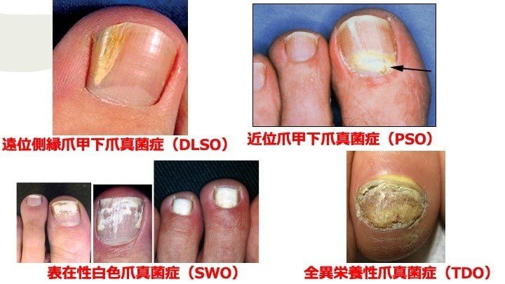 爪の真菌治療爪真菌ソリューション白癬クリア健康足の爪成長ネイルケア P1 ネイルトリートメント Aliexpress うなぎ爪 真菌症修復液でこぼこソフトネイル肥厚タイプ爪真菌症修復液足ブライトネイルケア液 Ciudaddelmaizslp Gob Mx