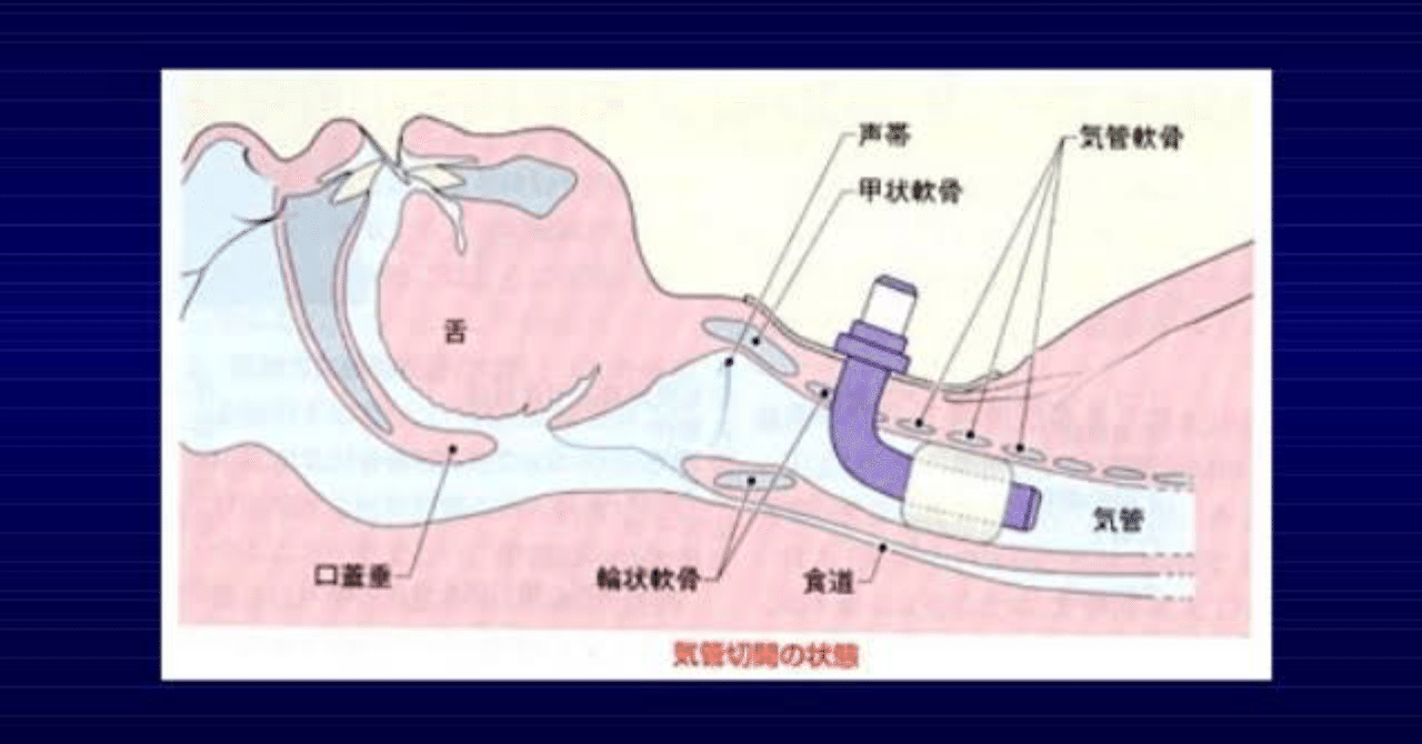 気管切開とは The Miyato Show Note