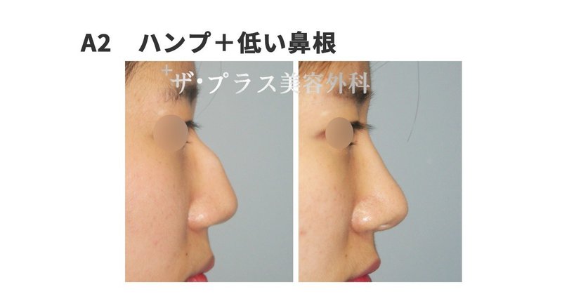 全てわかる 鷲鼻形成術 大解説集パート1 ザ プラス美容外科 東京代官山 Note 全てわかる 鷲鼻形成術 大解説集パート1 ザ プラス美容外科 東京代官山 Note