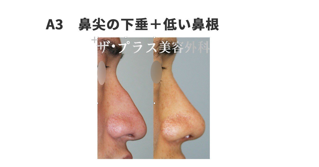 全てわかる 鷲鼻形成術 大解説集パート1 ザ プラス美容外科 東京代官山 Note 全てわかる 鷲鼻形成術 大解説集パート1 ザ プラス美容外科 東京代官山 Note