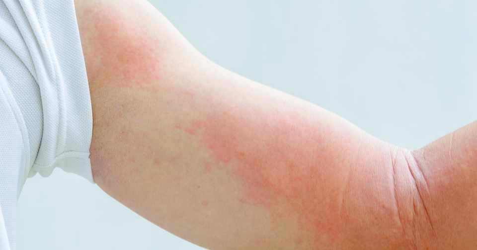 Images Of 蕁麻疹 Japaneseclass Jp