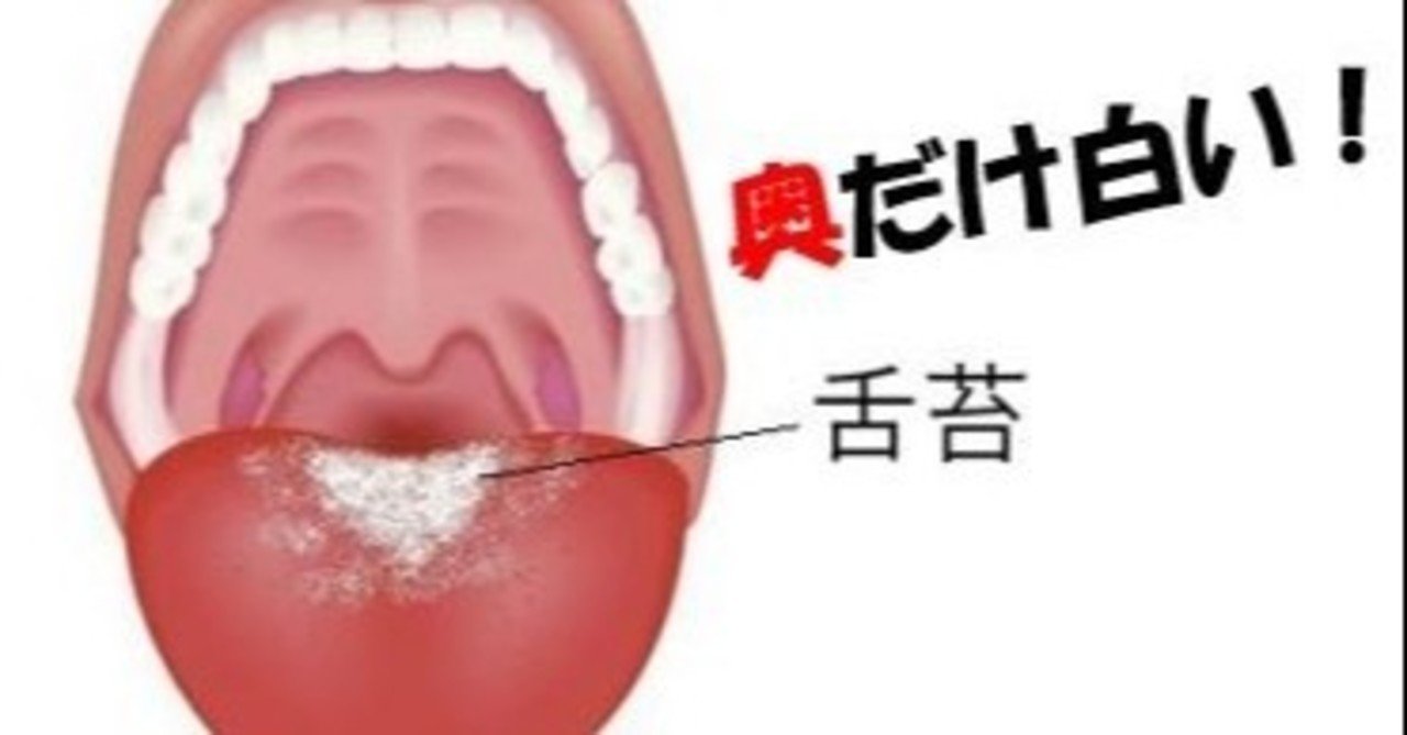 舌が白い人と白くない人5つの違い 舌苔の原因と取り方 Uebayashi Note