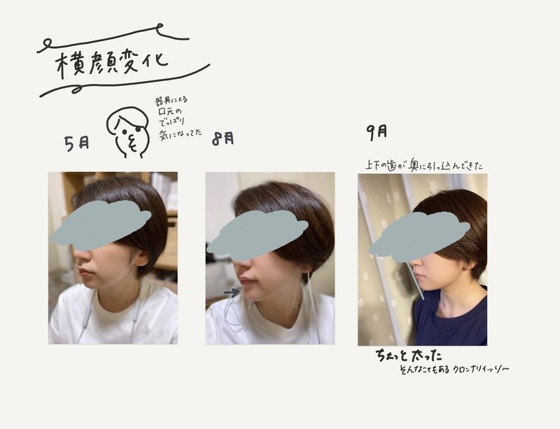 横顔で気づく太りとeライン 大人の歯列矯正 11ヶ月目 Miki Sato Note