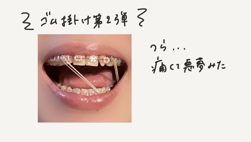 横顔で気づく太りとeライン 大人の歯列矯正 11ヶ月目 Miki Sato Note