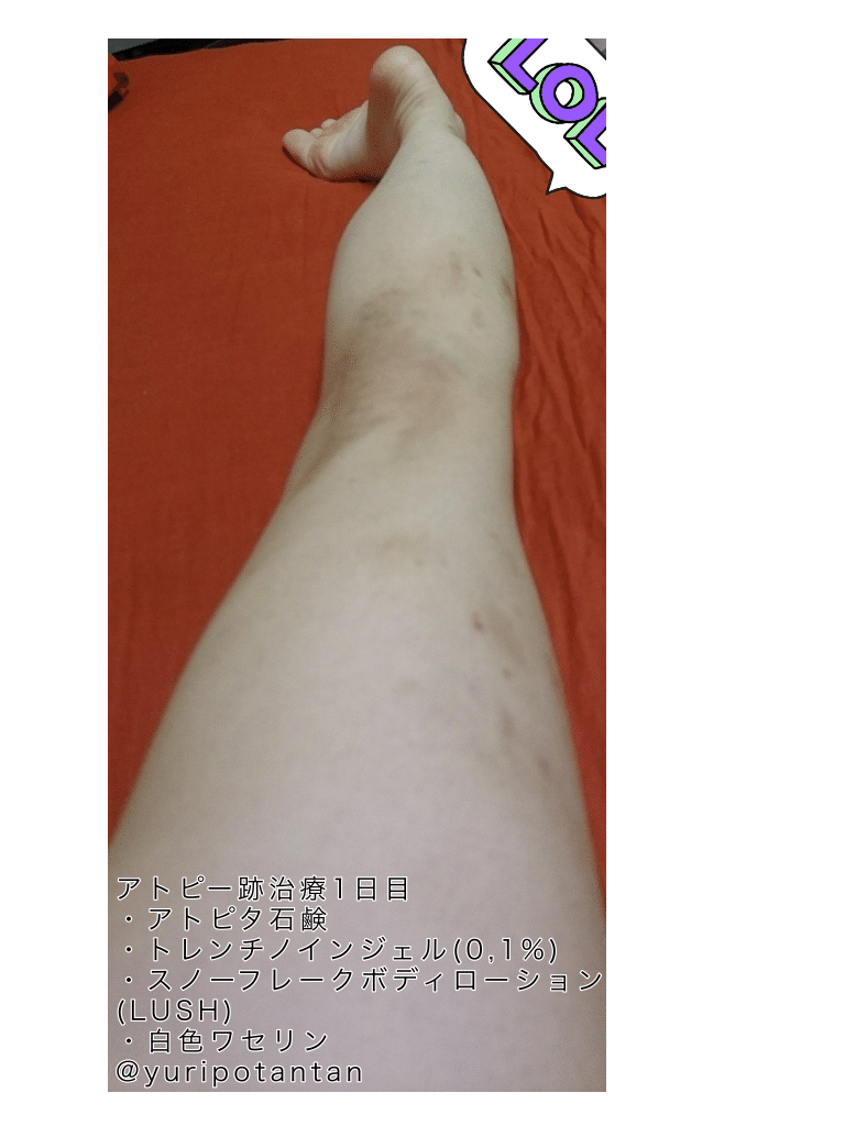 アトピー跡治療1週間目 ゆり Note