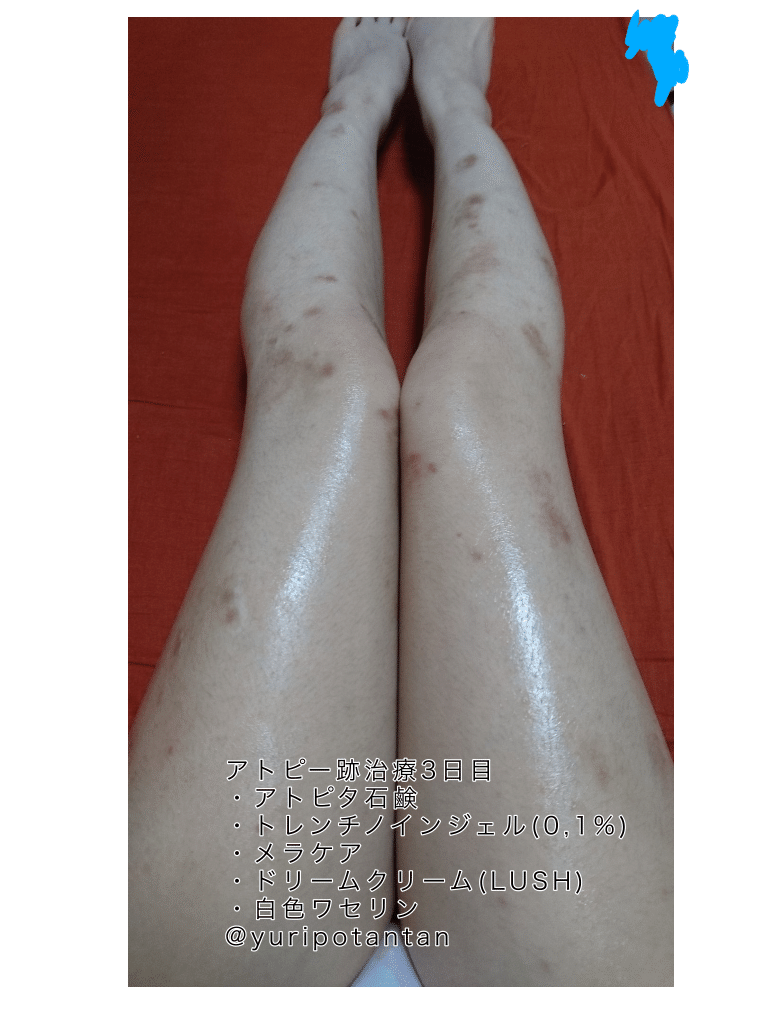 アトピー跡治療1週間目 ゆり Note