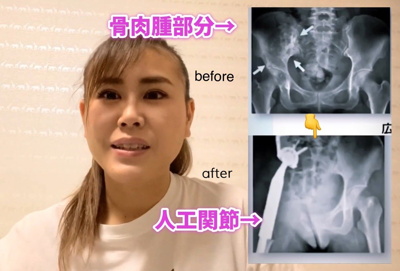 がんサバイバーナースましゅー 骨肉腫を語る Deletec大作戦 みおしん先生 Note