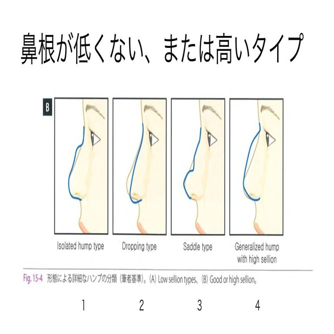 鷲鼻 わしばな 特集パート２ ザ プラス美容外科 東京代官山 Note