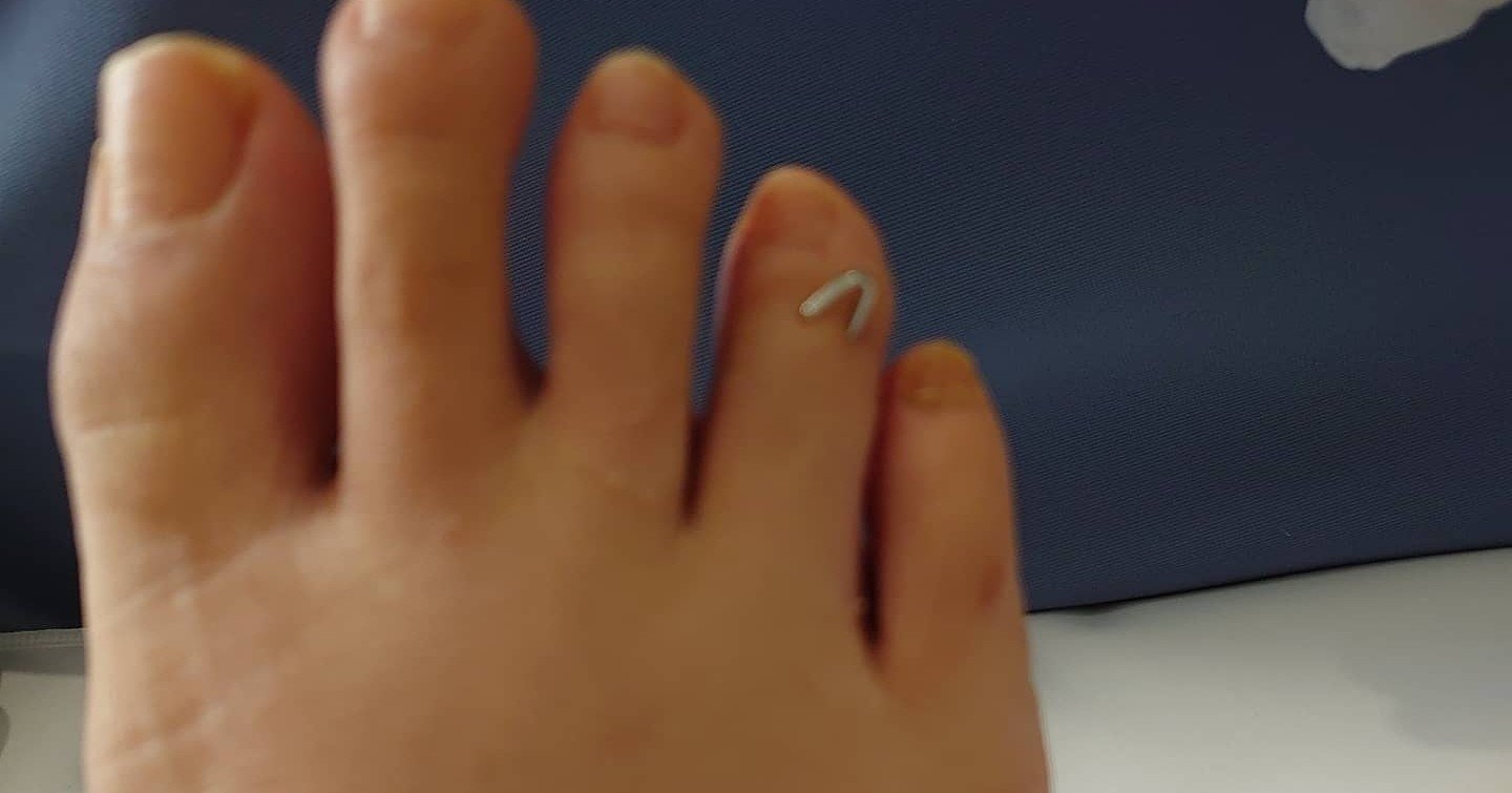 右足薬指 骨折 木村 智子 Note