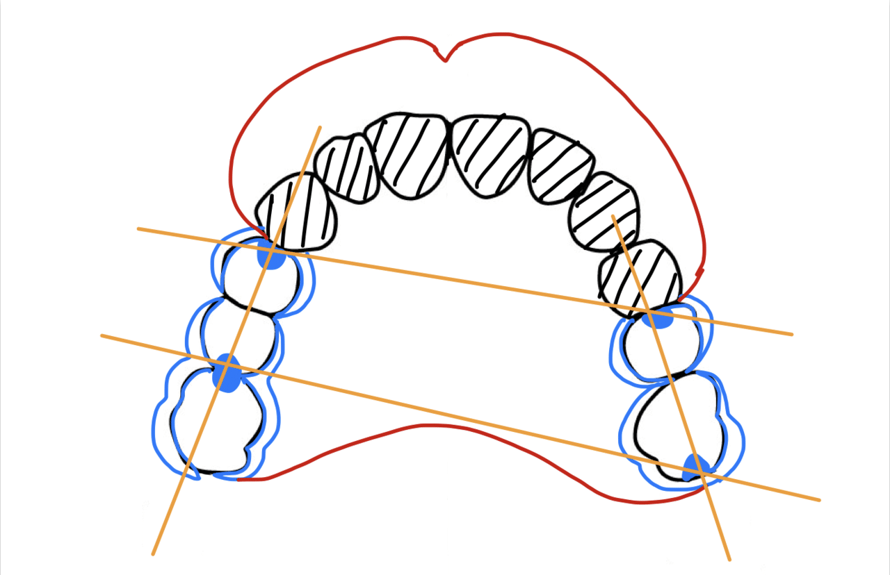 パーシャルデンチャーアトラス : デザイン理論と臨床/遊離端義歯を中心に ヨドバシ.com - パーシャルデンチャーアトラス―デザイン理論と