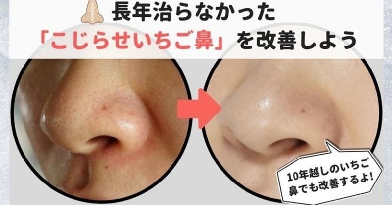 いちご鼻は一生治らないって思ってない 戦略的改善法とは 美容ライターまめ Note