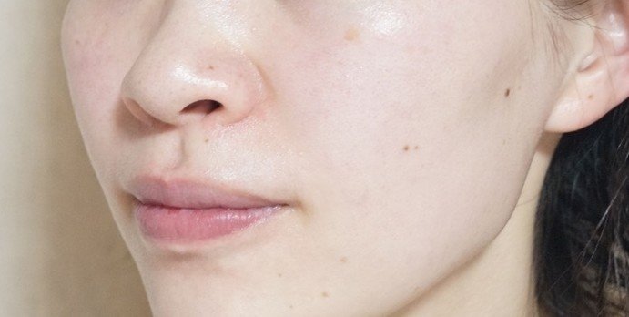 いちご鼻は一生治らないって思ってない どうしたら改善するの 美容ライターまめ Note