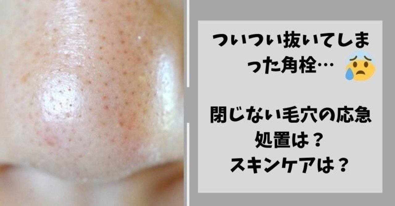 角栓抜いた後 毛穴がぽっかり 早く戻すにはどうしたらいいの 美容ライターまめ Note