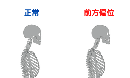 頭部前方偏位
