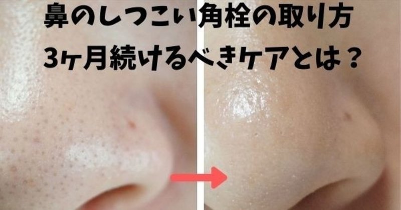 鼻の角栓が取れない しつこい角栓を取って毛穴を閉じる3ステップとは 美容ライターまめ Note