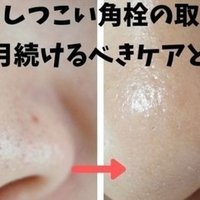 角栓抜いた後 毛穴がぽっかり 早く戻すにはどうしたらいいの 美容ライターまめ Note 角栓抜いた後 毛穴がぽっかり 早く戻すにはどうしたらいいの 美容ライターまめ Note