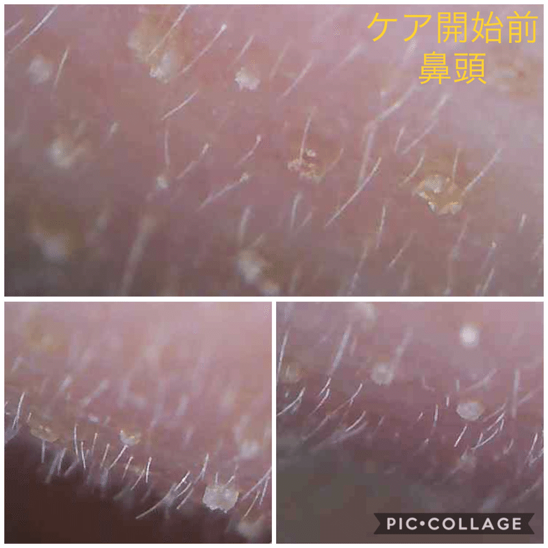 最大限に優しい角栓ケアはこれだ を見つけたかもしれないという話 ともみょす Note 最大限に優しい角栓ケアはこれだ を見つけたかもしれないという話 ともみょす Note
