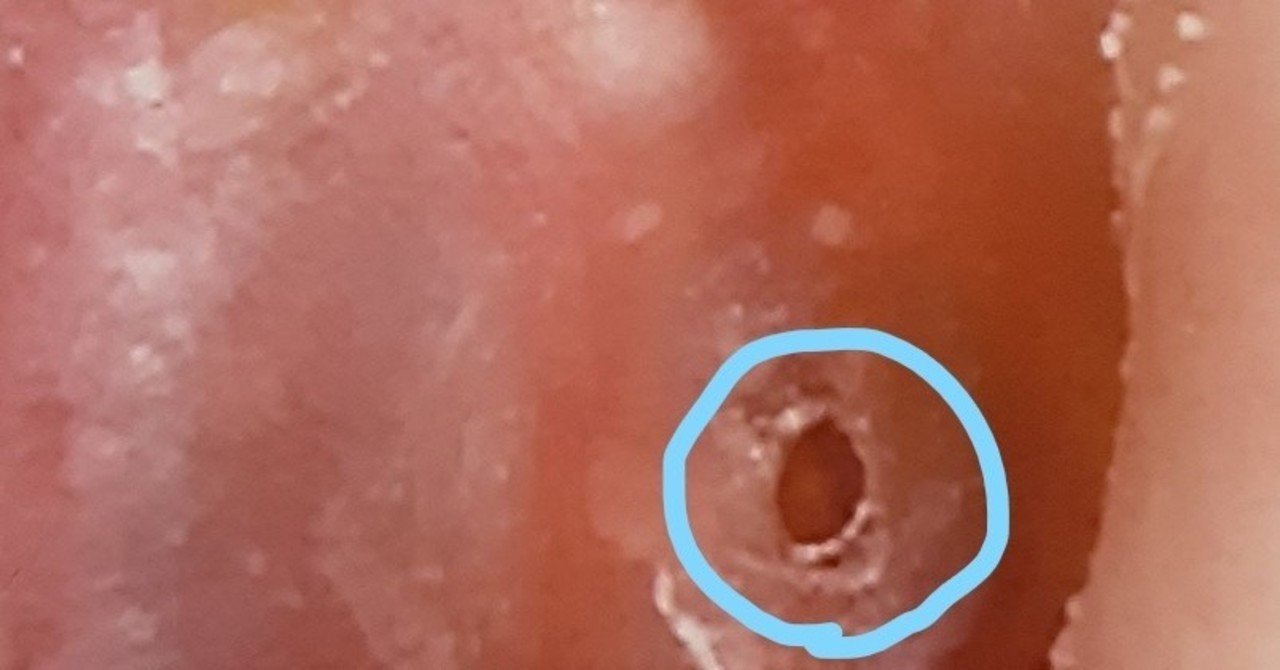 ダイビングで鼓膜が破れた話 モアイ Note ダイビングで鼓膜が破れた話 モアイ Note