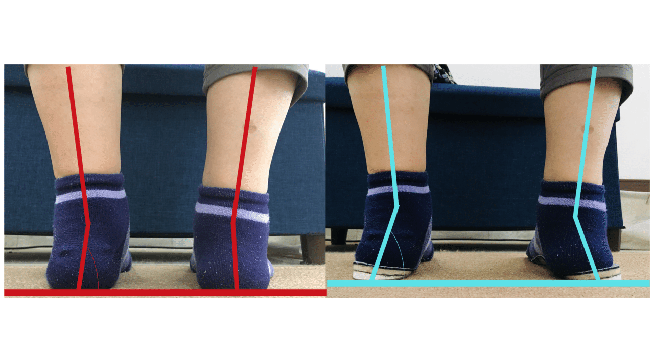 O脚の改善で絶対にやってはいけない事 こば Note O脚の改善で絶対にやってはいけない事 こば Note