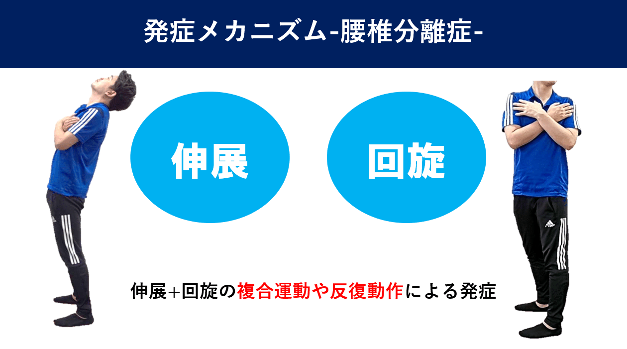 腰椎分離症 動作分析 佐藤 康 Note