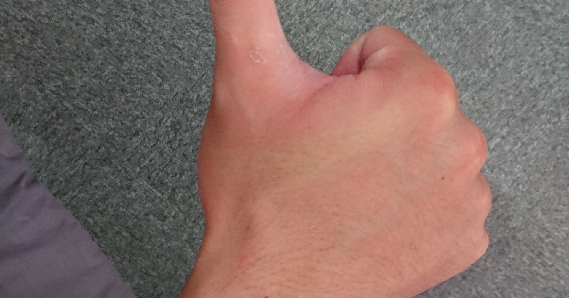 舟状骨骨折 前編 A D E 合同会社 Note 舟状骨骨折 前編 A D E 合同会社 Note