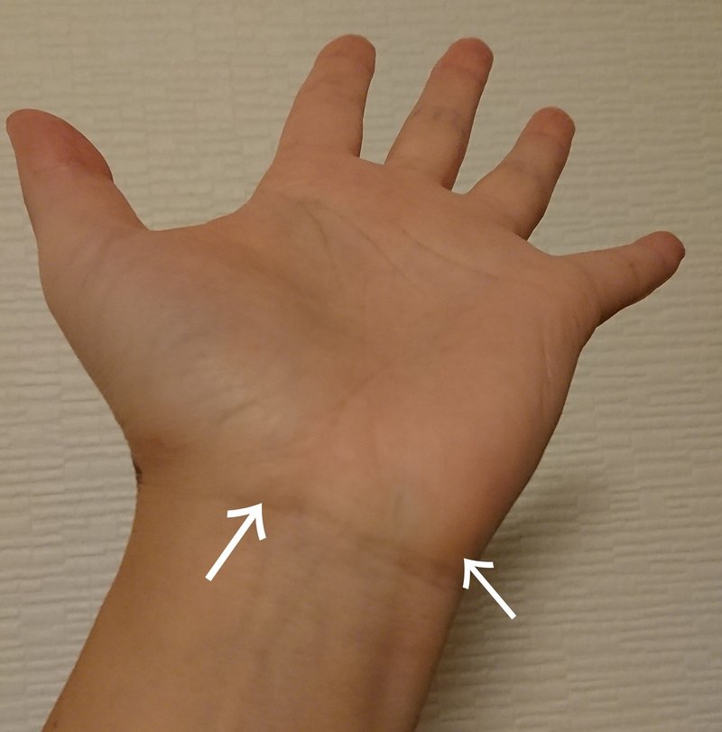 舟状骨骨折 前編 Athlete Development Edge Note 舟状骨骨折 前編 Athlete Development Edge Note